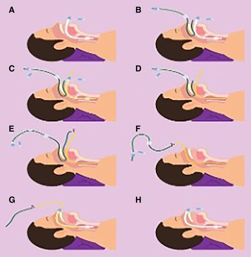 Oral to Nasal Endotracheal Tube Exchange: Modification to Enable Wider Applicability of an "Old Connector" Technique-A Case Report.