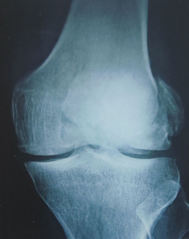 Management of Distal Femur Unicondylar Fractures by Calcaneal Buttress Plating: A Prospective Interventional Study.