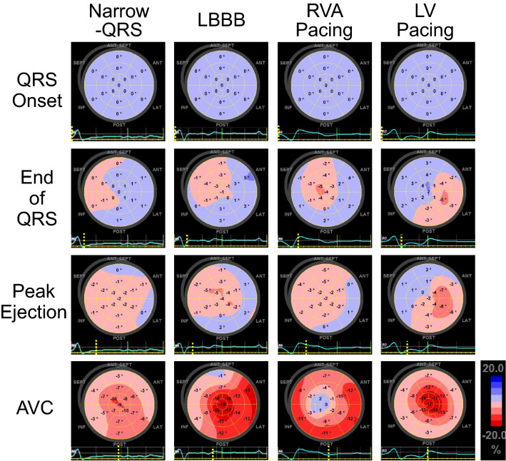 Estimation of left ventricular activation sequence in patients with heart failure using two-dimensional speckle tracking echocardiography.