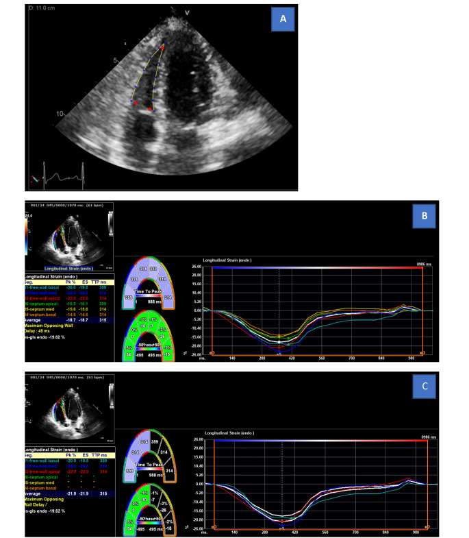 The prevalence of abnormal right ventricle speckle strain in the setting of acute myocarditis and preserved left ventricle function.