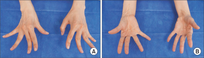 Intrinsic contracture of the hands in sarcoid myopathy.