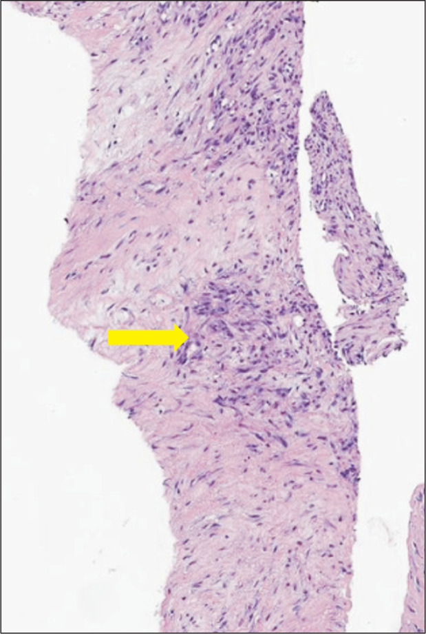 Intrinsic contracture of the hands in sarcoid myopathy.