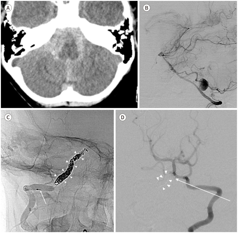 [Endovascular Treatment for Head and Neck Trauma].