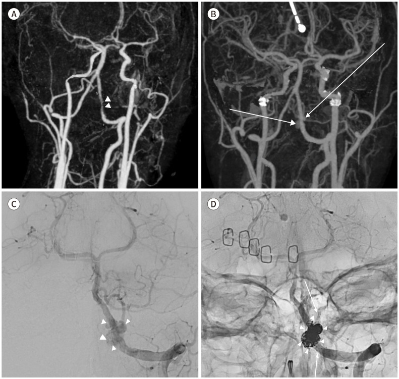 [Endovascular Treatment for Head and Neck Trauma].