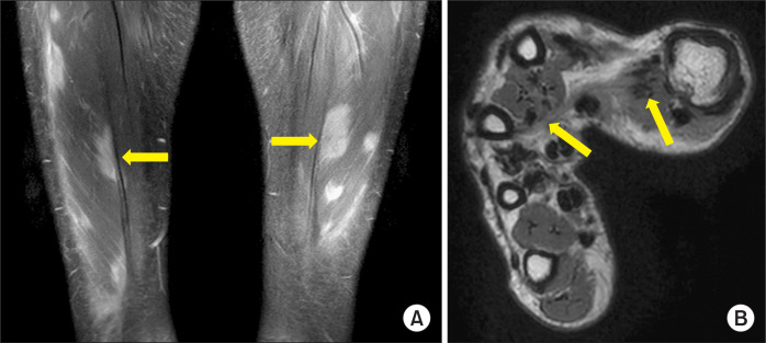 Intrinsic contracture of the hands in sarcoid myopathy.