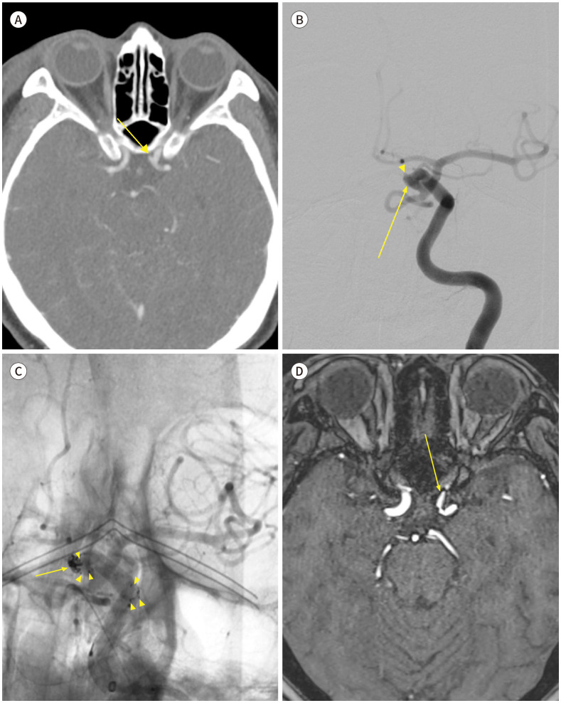 [Endovascular Treatment for Head and Neck Trauma].