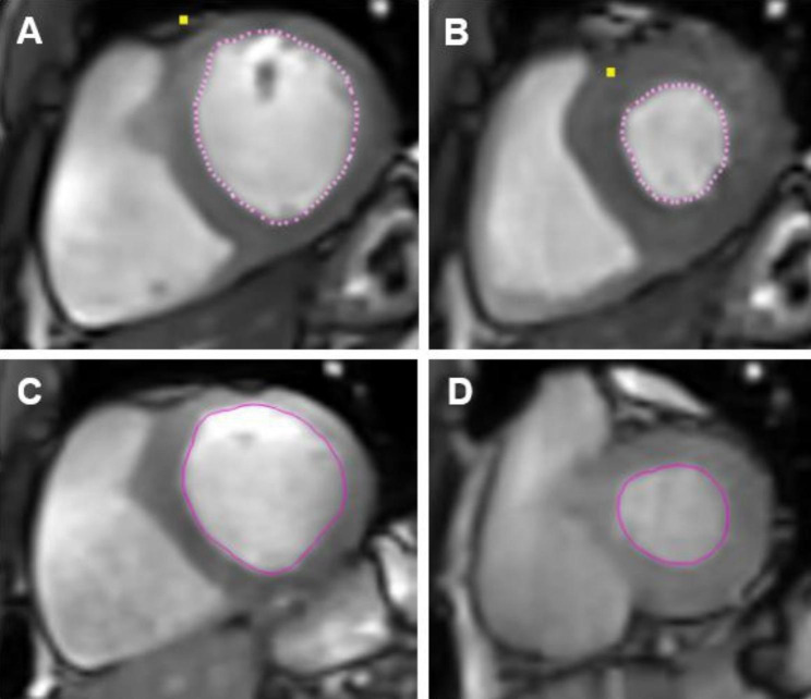 Simultaneous exercise stress cardiac magnetic resonance and cardiopulmonary exercise testing to elucidate the Fick components of aerobic exercise capacity: a feasibility and reproducibility study and pilot study in hematologic cancer survivors.