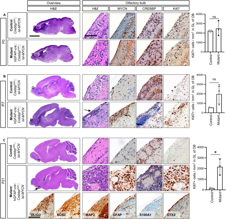 The tumor suppressor CREBBP and the oncogene MYCN cooperate to induce malignant brain tumors in mice.