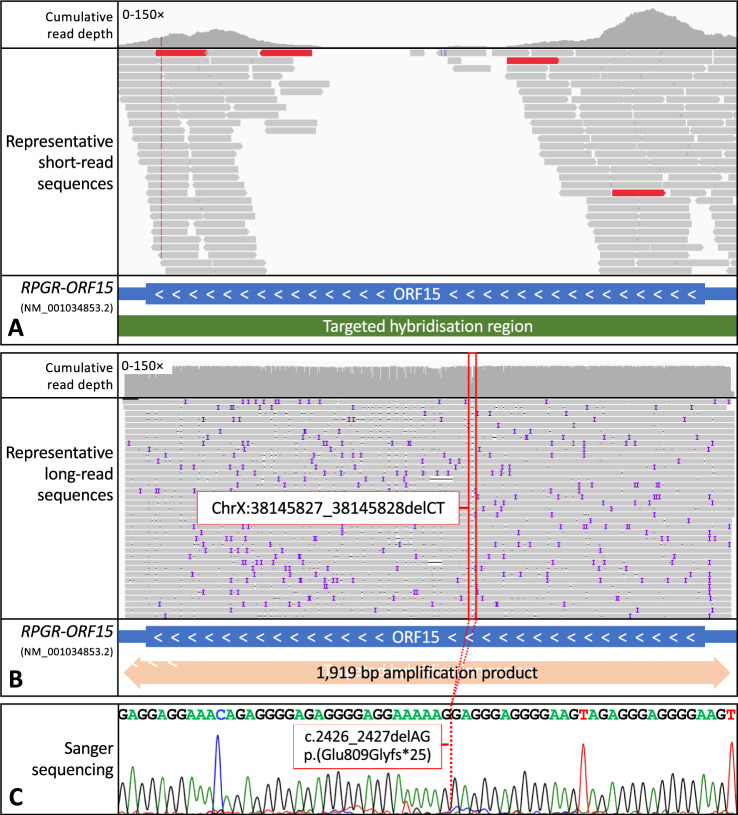 Long-Read Nanopore Sequencing of RPGR ORF15 is Enhanced Following DNase I Treatment of MinION Flow Cells.