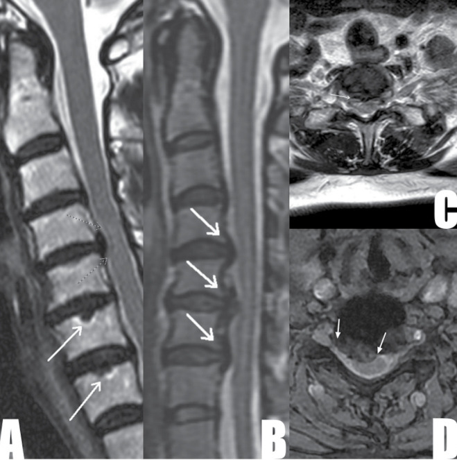 Association of Cervical Spine Magnetic Resonance Imaging Abnormalities with Chronic Neck Pain in Southern Nigeria.