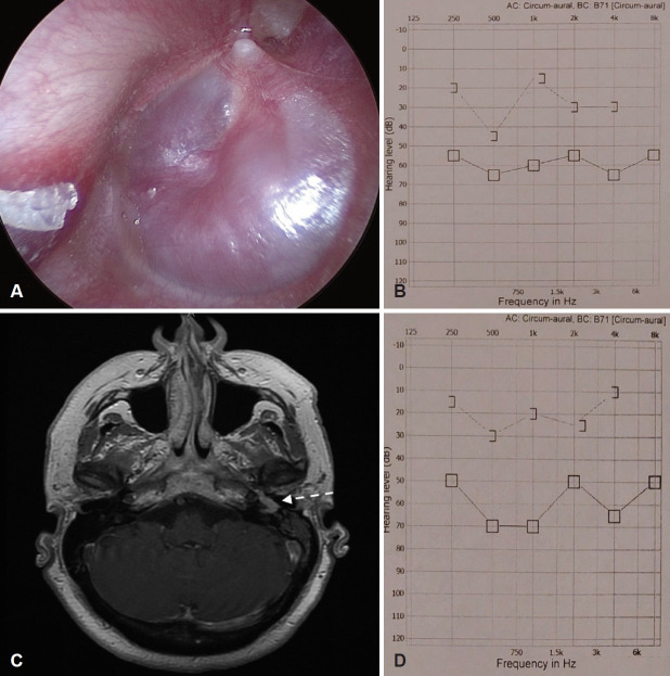 Endoscopic Management of Glomus Tympanicum Tumor: Report of Three Cases and Review of the Literature.