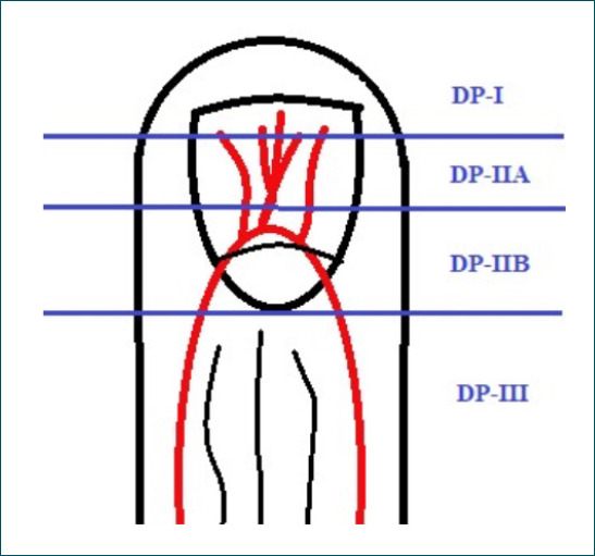 Composite graft repair in distal finger injuries: emergency room or operating room?