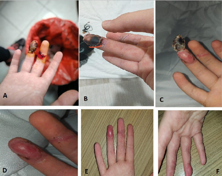 Composite graft repair in distal finger injuries: emergency room or operating room?