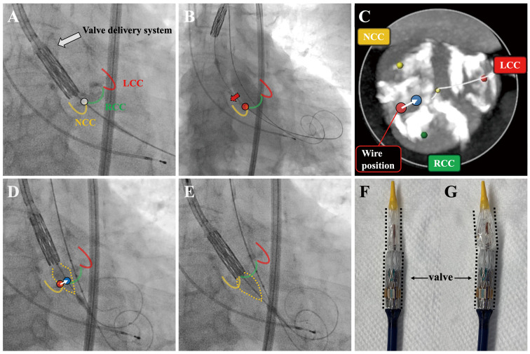 Distal Balloon Inflation Technique　- A Bailout Method of Difficulty in Crossing Balloon-Expandable Valve Delivery System Due to Unfavorable Guidewire Position During Transcatheter Aortic Valve Replacement.