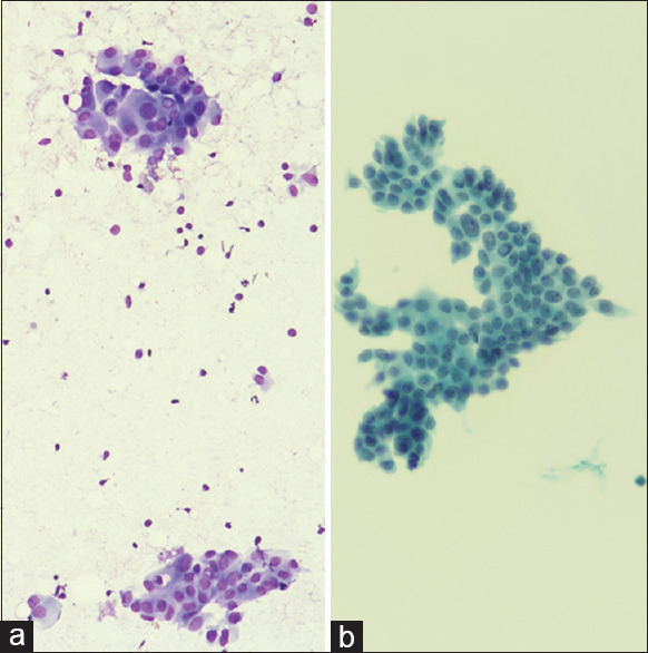 The Similarities and Differences between Liquid-based and Conventional Methods in Evaluation of Thyroid Fine Needle Aspiration Cytologies.