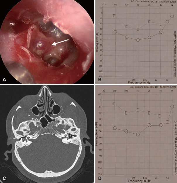 Endoscopic Management of Glomus Tympanicum Tumor: Report of Three Cases and Review of the Literature.