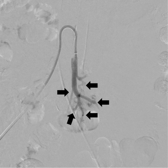 A Case of Refractory Esophageal Varices Caused by an Inferior Mesenteric Arteriovenous Malformation with All Portal System Occlusion Successfully Treated via Transarterial Embolization.