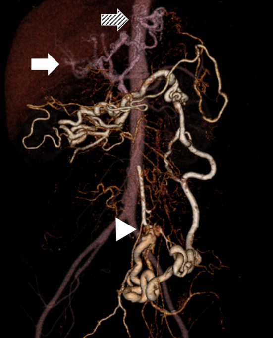 A Case of Refractory Esophageal Varices Caused by an Inferior Mesenteric Arteriovenous Malformation with All Portal System Occlusion Successfully Treated via Transarterial Embolization.