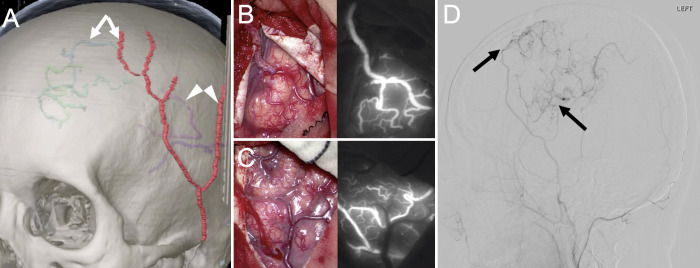 Disappearance of a moyamoya-related distal anterior cerebral artery aneurysm after target bypass revascularization: illustrative case.