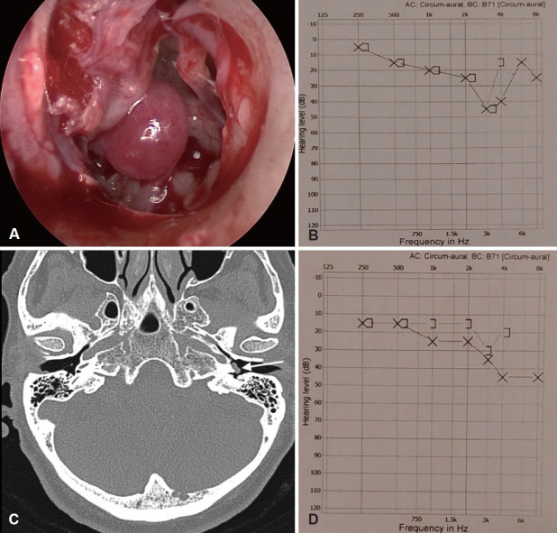 Endoscopic Management of Glomus Tympanicum Tumor: Report of Three Cases and Review of the Literature.