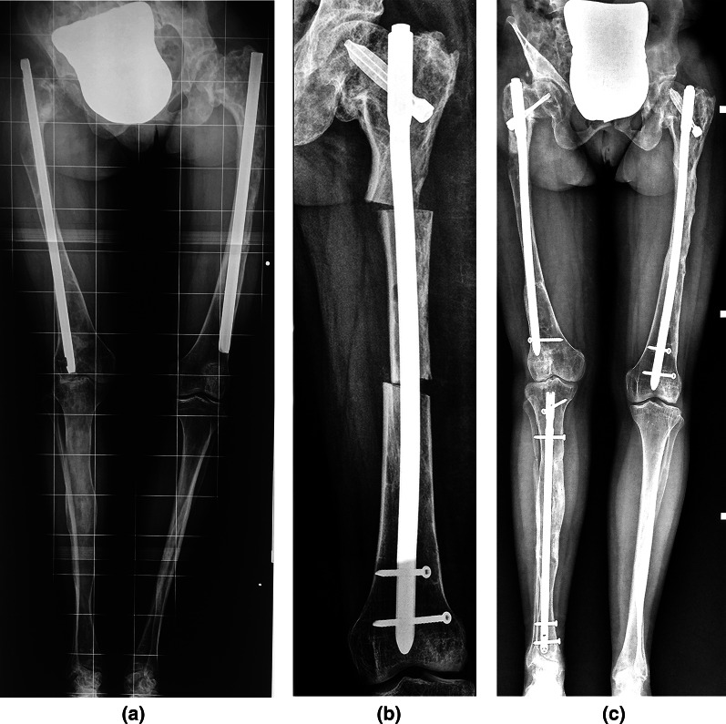 Lower-limb intramedullary nailing in patients with polyostotic fibrous dysplasia who had a previous unsuccessful treatment. A report of 48 cases.