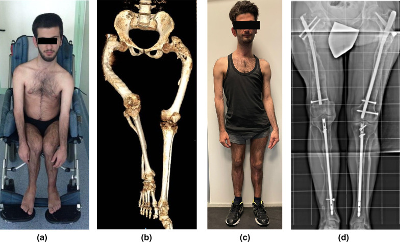 Lower-limb intramedullary nailing in patients with polyostotic fibrous dysplasia who had a previous unsuccessful treatment. A report of 48 cases.