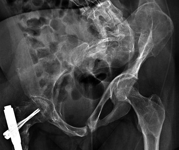 Lower-limb intramedullary nailing in patients with polyostotic fibrous dysplasia who had a previous unsuccessful treatment. A report of 48 cases.