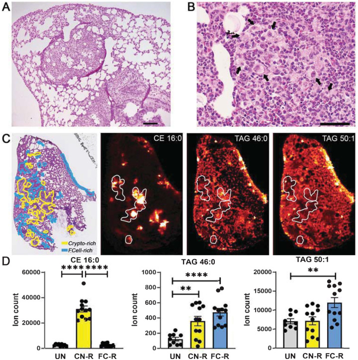 Cryptococcosis, tuberculosis, and a kidney cancer fail to fit the atherosclerosis paradigm for foam cell lipid content.