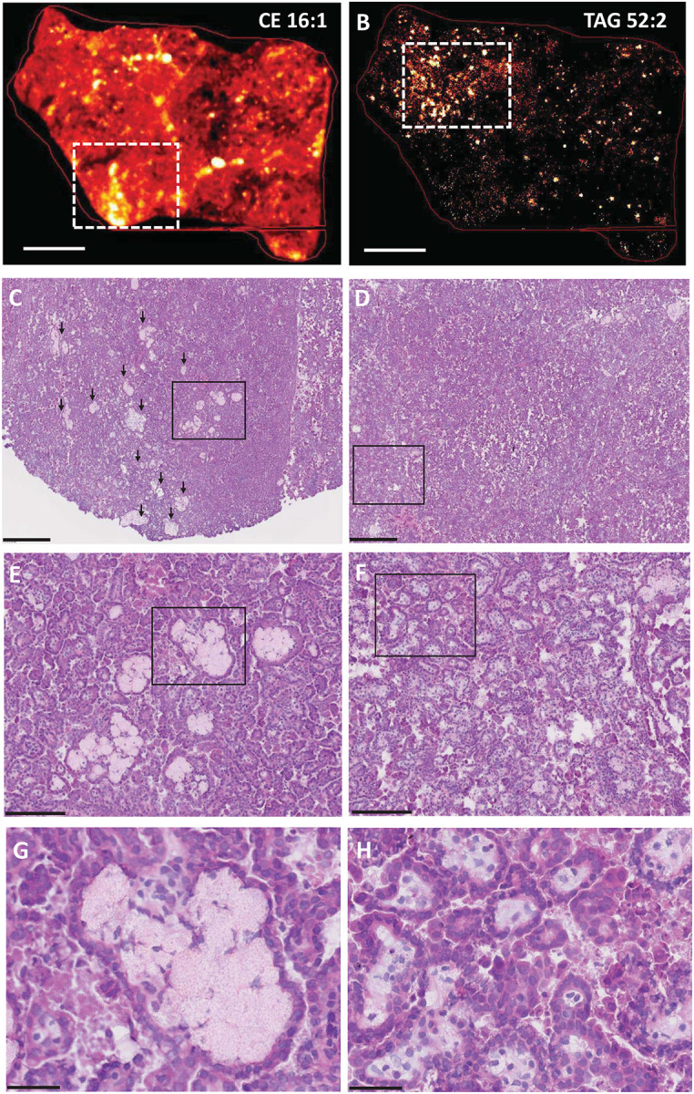 Cryptococcosis, tuberculosis, and a kidney cancer fail to fit the atherosclerosis paradigm for foam cell lipid content.