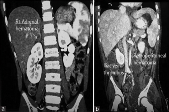 Spectrum of paediatric blunt abdominal trauma in a tertiary care hospital in India.