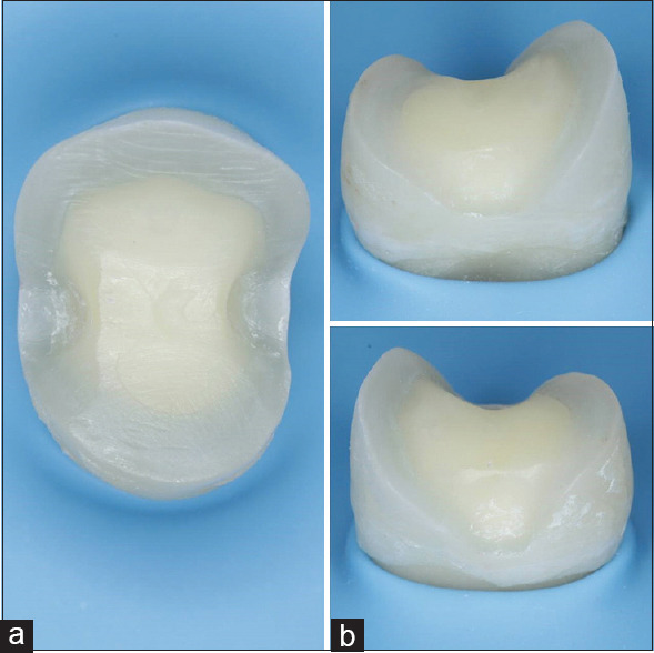 Effect of immediate dentin sealing on the fracture strength of indirect overlay restorations using different types of luting agents (A comparative <i>in vitro</i> study).