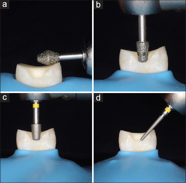 Effect of immediate dentin sealing on the fracture strength of indirect overlay restorations using different types of luting agents (A comparative <i>in vitro</i> study).