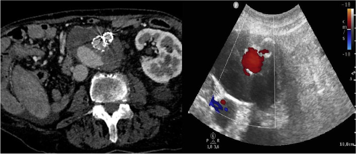 Complex endoleak treatment after failed endovascular aortic repair.