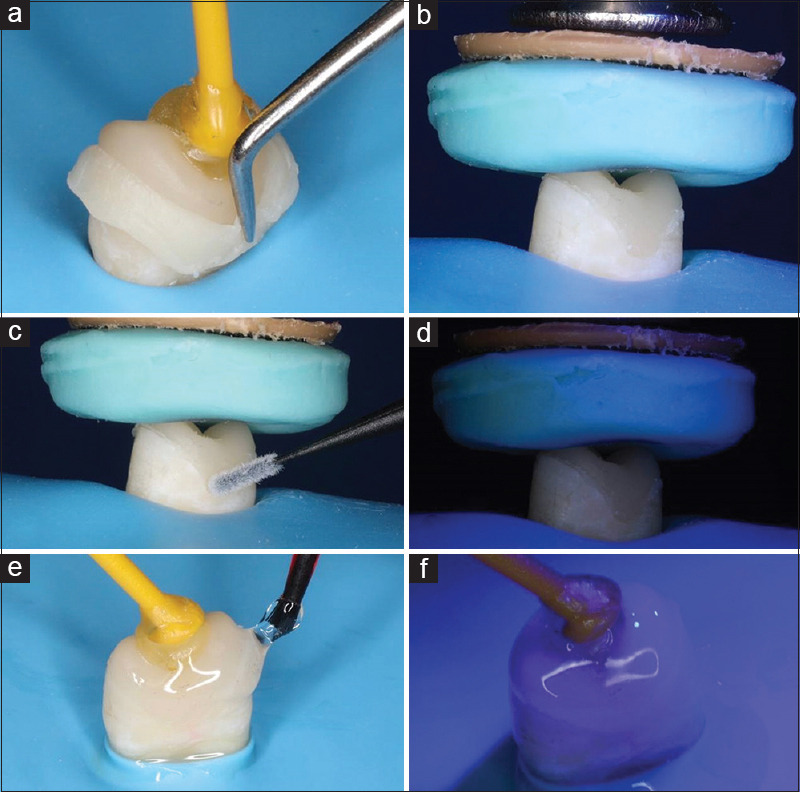 Effect of immediate dentin sealing on the fracture strength of indirect overlay restorations using different types of luting agents (A comparative <i>in vitro</i> study).