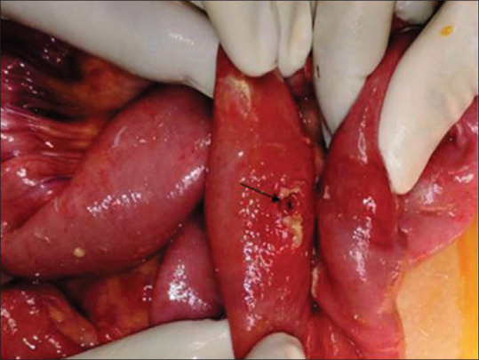 Spectrum of paediatric blunt abdominal trauma in a tertiary care hospital in India.