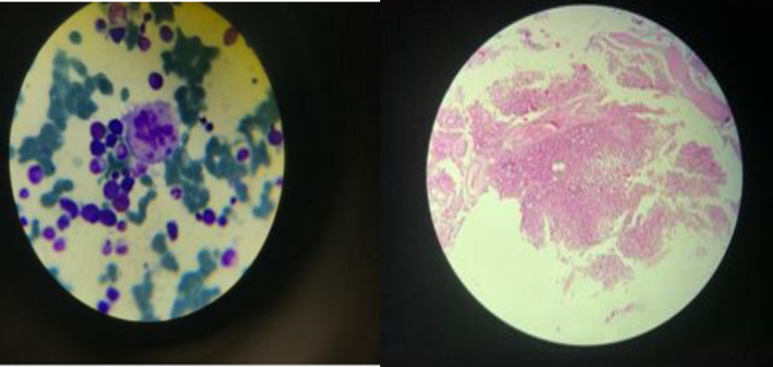 Pernicious Anemia Following COVID-19 Vaccination: A Report of Two Cases.