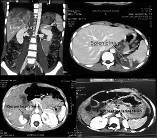 Spectrum of paediatric blunt abdominal trauma in a tertiary care hospital in India.