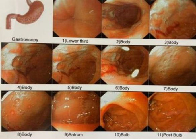 Pernicious Anemia Following COVID-19 Vaccination: A Report of Two Cases.