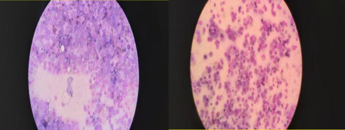 Pernicious Anemia Following COVID-19 Vaccination: A Report of Two Cases.