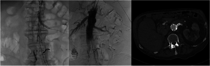 Complex endoleak treatment after failed endovascular aortic repair.