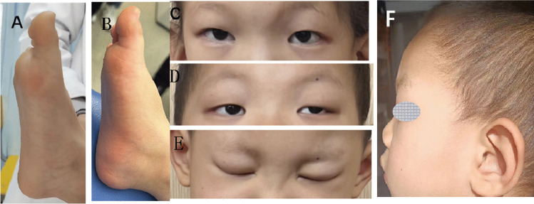 Clinical characterization of familial 1p36.3 microduplication.