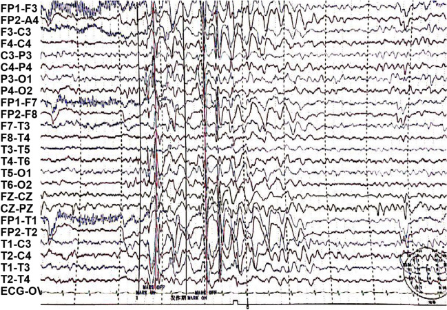 Clinical characterization of familial 1p36.3 microduplication.