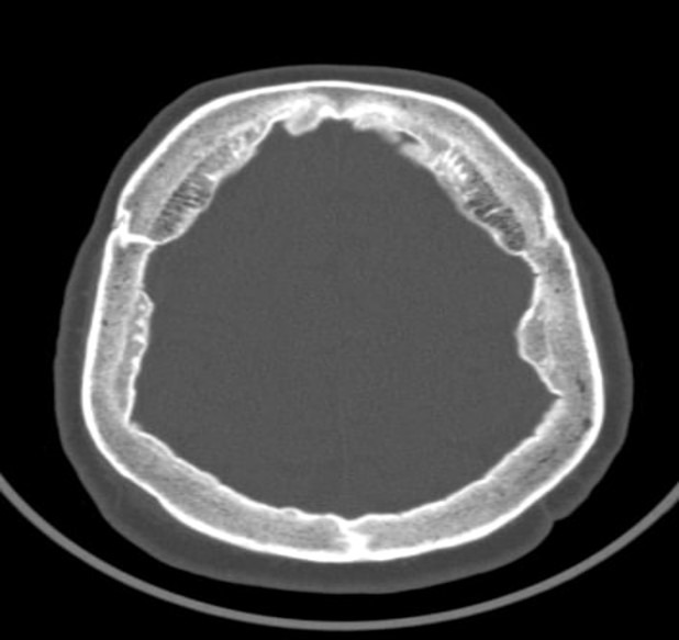 Morgagni-Stewart-Morel syndrome presenting with neurological symptoms: a case report.