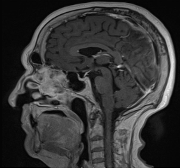 Morgagni-Stewart-Morel syndrome presenting with neurological symptoms: a case report.