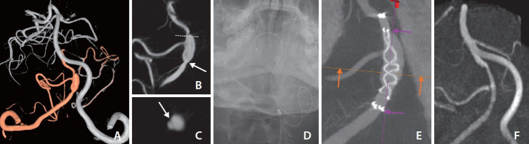 Flow Diverter Treatment Using a Flow Re-Direction Endoluminal Device for Unruptured Intracranial Vertebral Artery Dissecting Aneurysm: Single-Center Case Series and Technical Considerations.