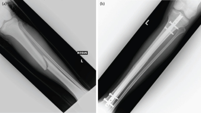 Compartment Syndrome following Intramedullary Nail Fixation in Closed Tibial Shaft Fractures.