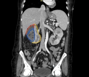 A Patient with Generalized Weakness - A Case Report.