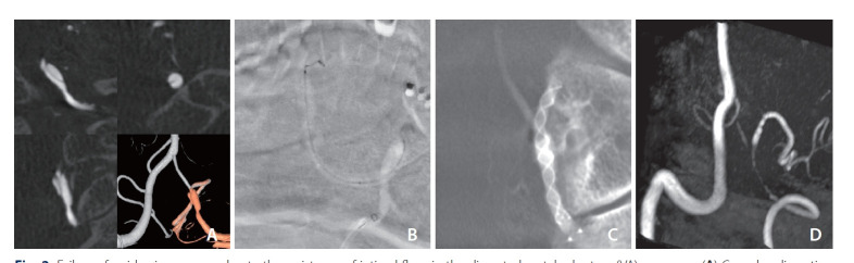 Flow Diverter Treatment Using a Flow Re-Direction Endoluminal Device for Unruptured Intracranial Vertebral Artery Dissecting Aneurysm: Single-Center Case Series and Technical Considerations.