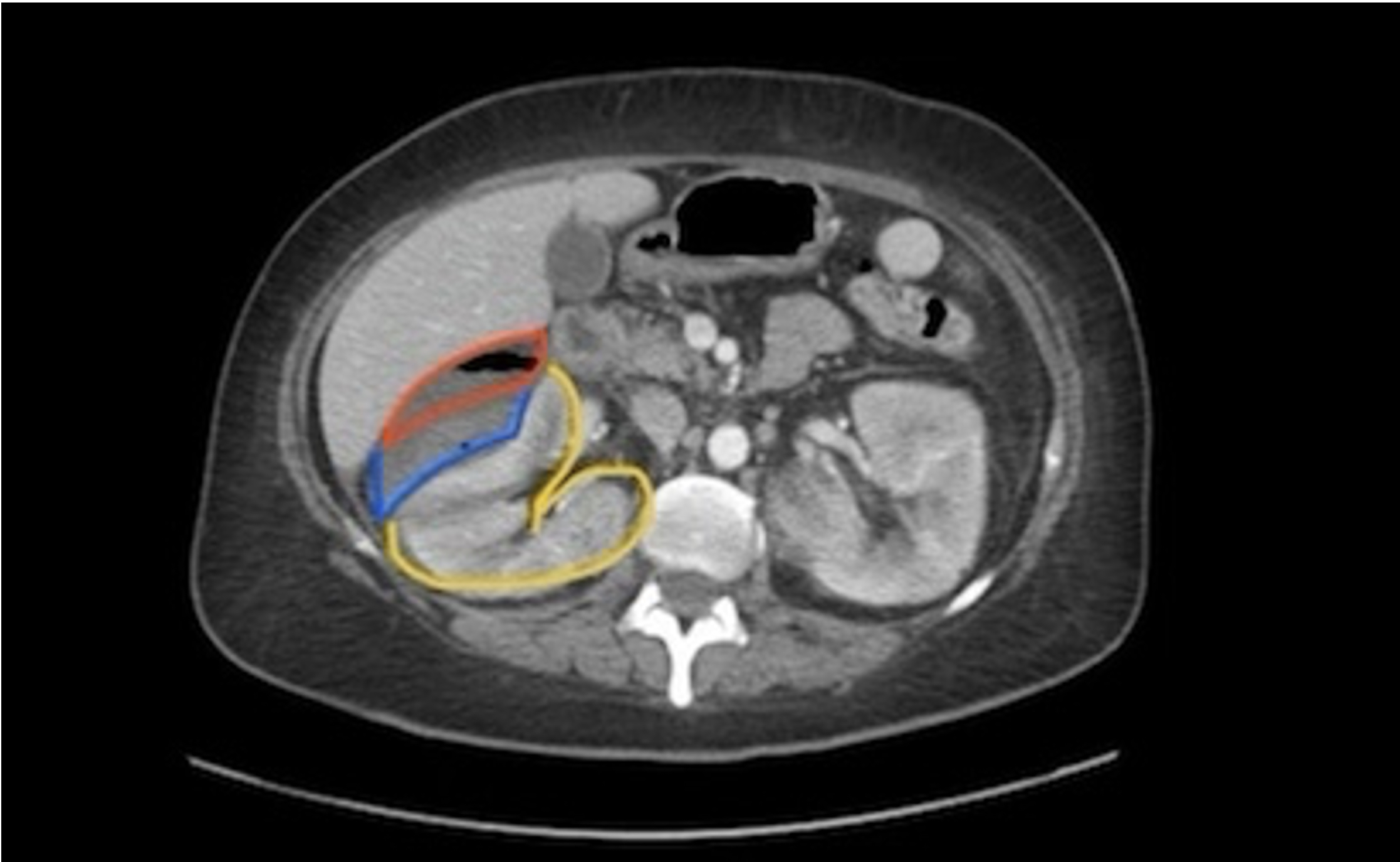 A Patient with Generalized Weakness - A Case Report.