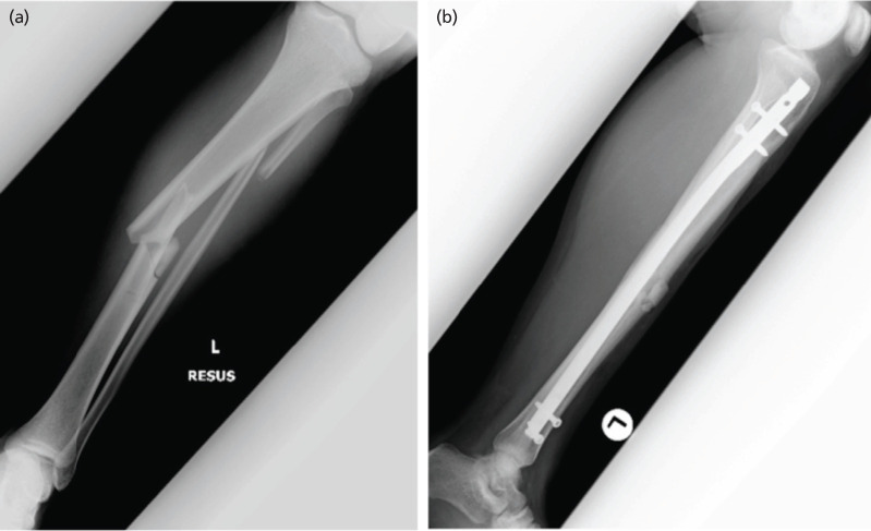 Compartment Syndrome following Intramedullary Nail Fixation in Closed Tibial Shaft Fractures.